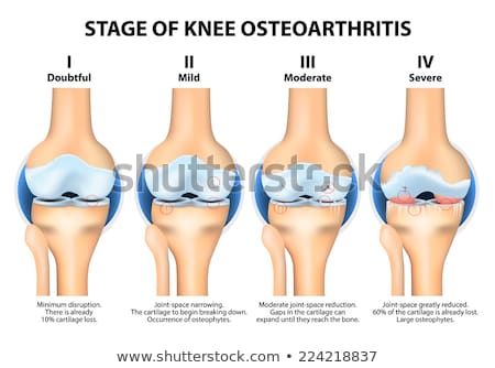 Foto stock: Stages Of Knee Osteoarthritis Oa