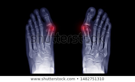 Zdjęcia stock: Diagnosis - Hallux Valgus Medical Concept