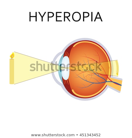 Human Vision Disorder Hyperopia Hyperopia Is Being Farsighted Foto d'archivio © Neokryuger