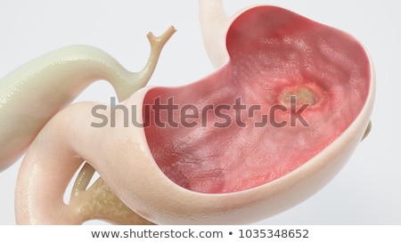 Stock photo: Peptic Ulcer Disease Medicine 3d Illustration