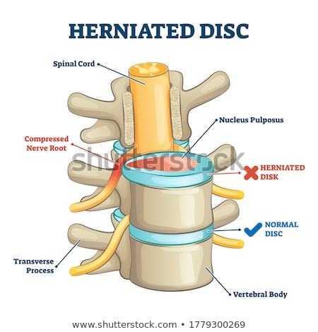 Stockfoto: Herniated Disk