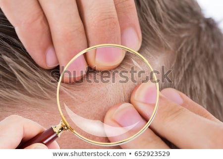 Foto stock: Dermatologist Checking Patients Hair With Magnifying Glass