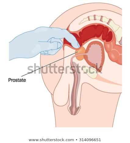Rectal Examination For Enlarged Prostate Stock foto © Blamb