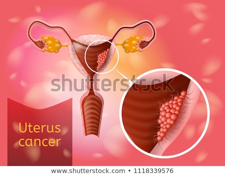 Сток-фото: Uterus Cancer