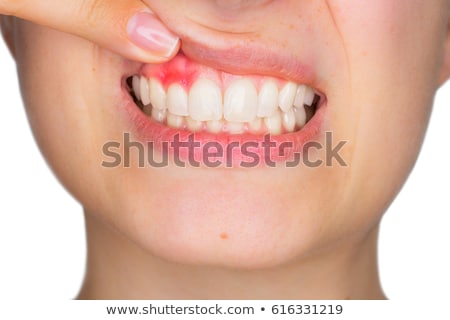 Stock fotó: Gum Disease