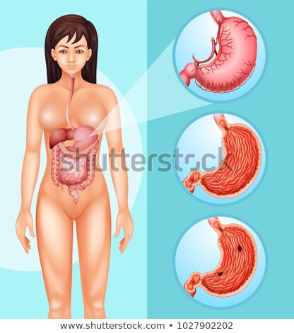 Stock photo: Diagram Showing Woman And Cancer In Stomach