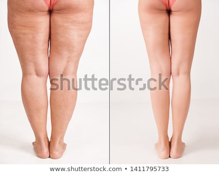 Stock photo: Treatment Of Varicose Before And After