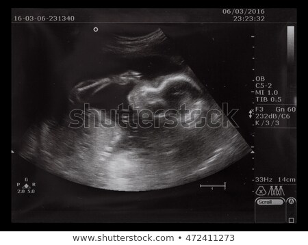 Foto stock: Photo A Child In The Picture Ultrasound