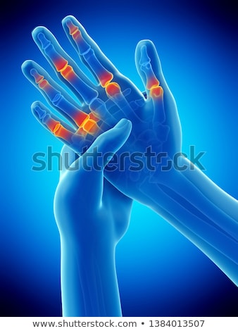 Stockfoto: 3d Rendered Illustration Of Painful Finger Joints
