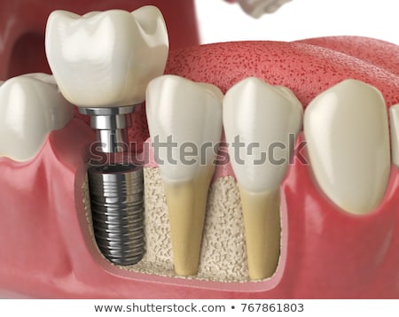 Stock fotó: Dental Implant Implanted In Jaw