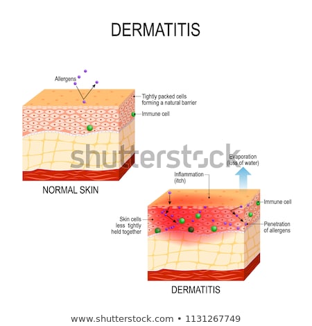 Zdjęcia stock: A Vector Of Hives On Human Skin