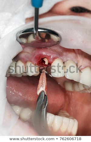 Stock photo: Dentist Removes Tooth