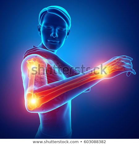 Foto stock: 3d Rendered Illustration - Painful Arm