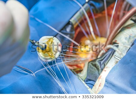 Сток-фото: Heart Valve Surgery