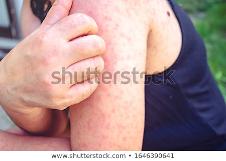 ストックフォト: Measles Disease Symptoms