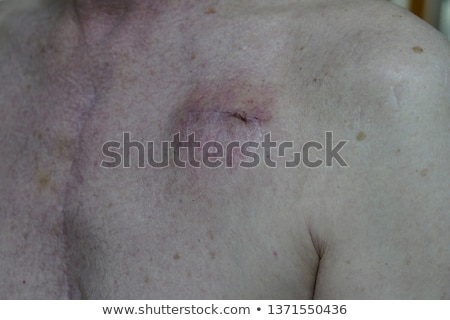 Сток-фото: Pacemaker Scar