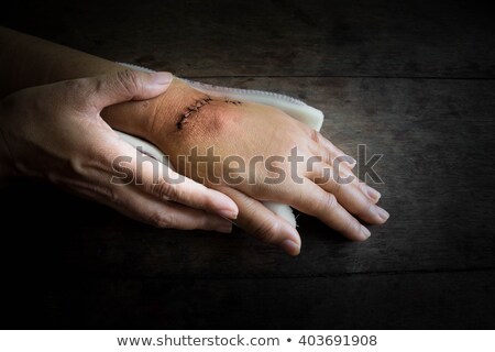 Foto stock: Hands In Dark Suture Wound On Hand Pain Of Accident Concept