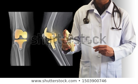 Foto stock: Prosthesis Of The Knee