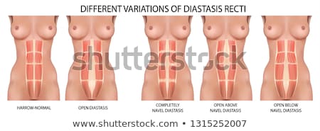 Stockfoto: Diastasis Recti Or Abdominal Separation