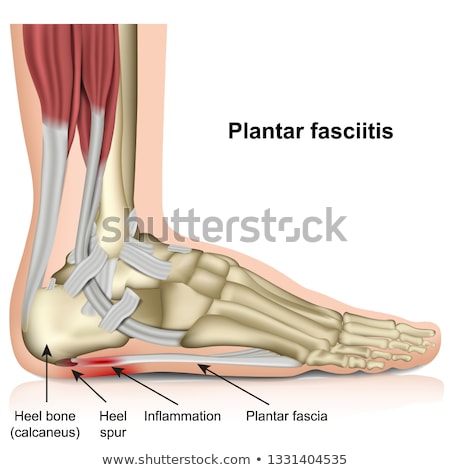 Stock fotó: Heel Spur Medicine 3d Illustration