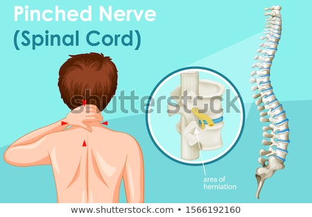 Foto stock: Diagram Showing Pinched Nerve In Human