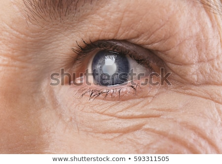 Stok fotoğraf: Cataracts