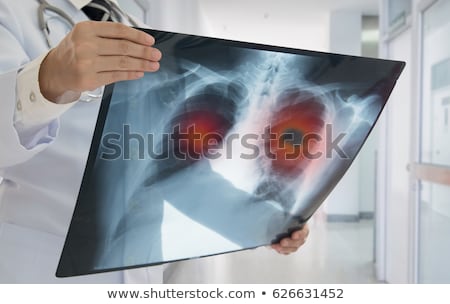 Stock fotó: Respiratory System Smoker Lung Cancer