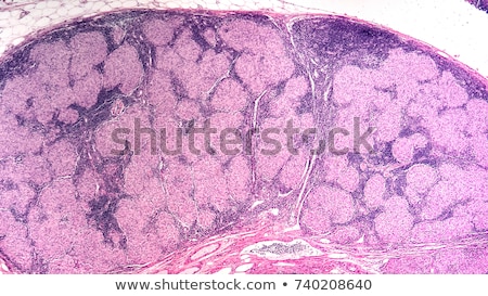 Stock photo: Sarcoidosis Signs And Symptoms