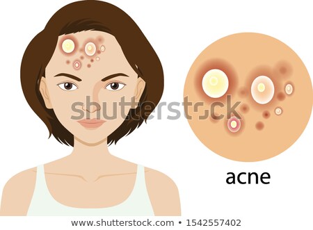 Foto d'archivio: Diagram Showing Woman With Acne Problem