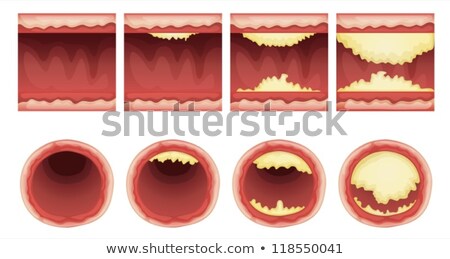 Stock photo: Artery Blocked With Cholesterol