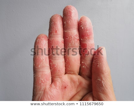 Stock fotó: Eczema On Finger