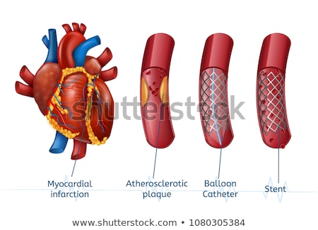 Stockfoto: Angioplasty