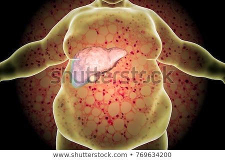 Stockfoto: Fatty Liver Disease