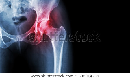 Сток-фото: Arthritis Of The Hip Joint