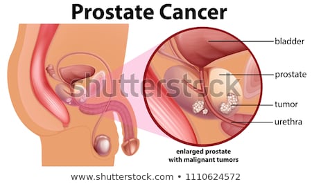 Stok fotoğraf: Diagram Of Prostate Cancer
