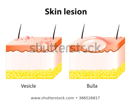 Foto stock: Vesicle And Bulla Skin Lesion