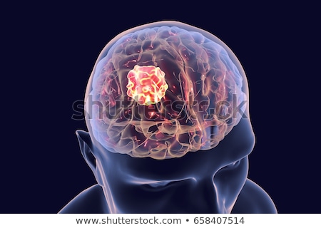 Stock foto: 3d Rendered Illustration - Brain Tumor