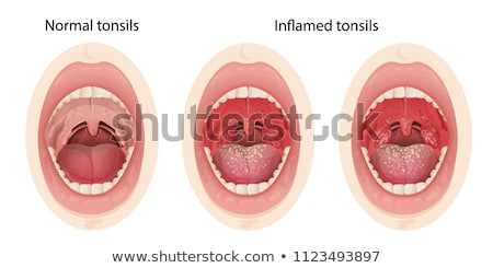 Stock fotó: Human Mouth Anatomy Of Ulcers