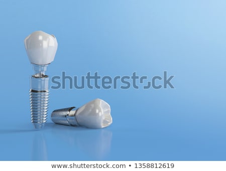 Foto stock: Mplante · de · dente · humano · e · titânio