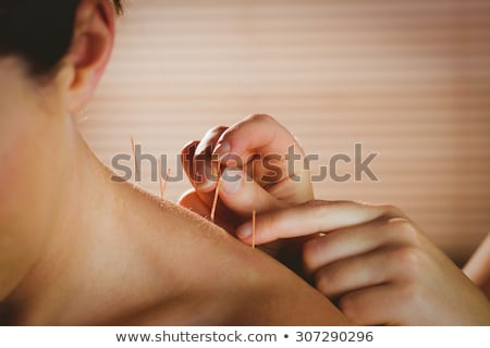 Zdjęcia stock: Young Woman Getting Acupuncture Treatment