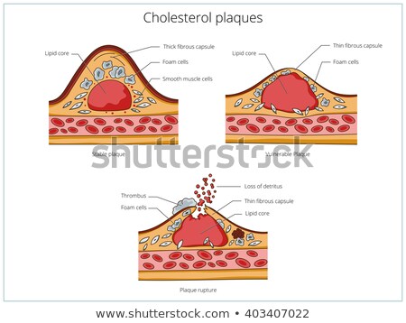 ストックフォト: Atherosclerosis Stable Plaque Formation