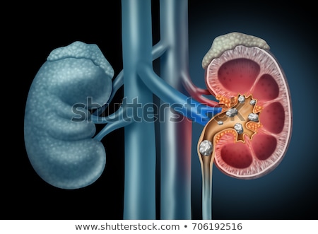 Stock fotó: Human And Kidney Stones