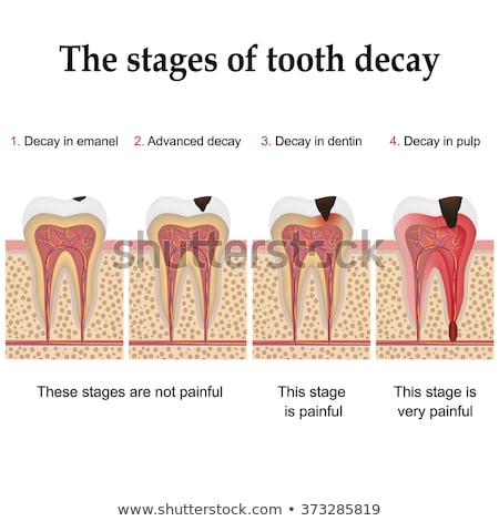 Dental Caries Formation Foto d'archivio © Neokryuger