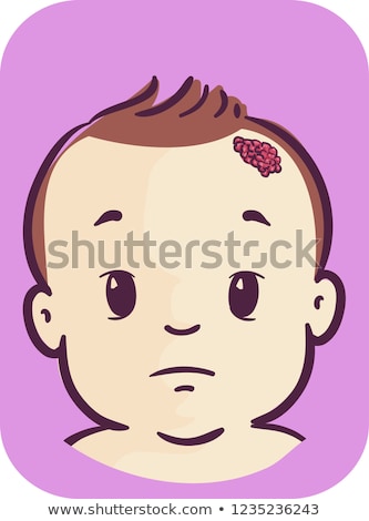 Stock photo: Baby Symptom Strawberry Nevus Illustration