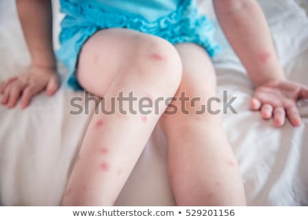 Stock photo: Mosquito Bite