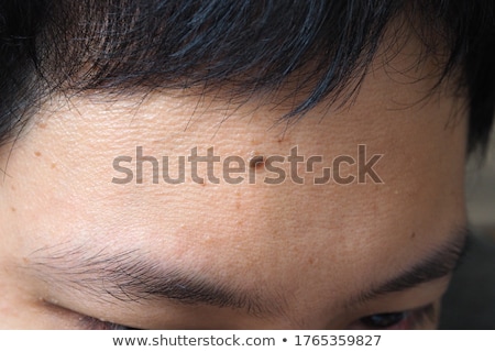 Foto stock: Forehead Wound