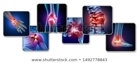 Foto d'archivio: Osteoarthritis Or Arthritis