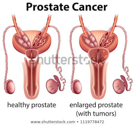 Foto stock: Comparison Of Healthy And Cancer Prostate