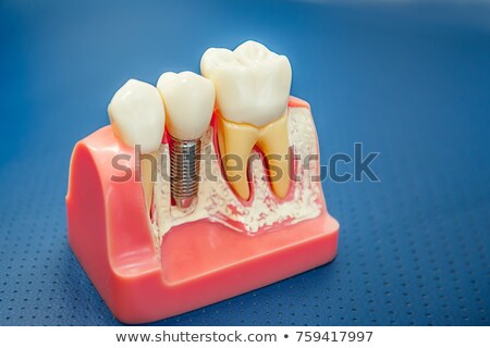 Сток-фото: Dental Tooth Implant Parts