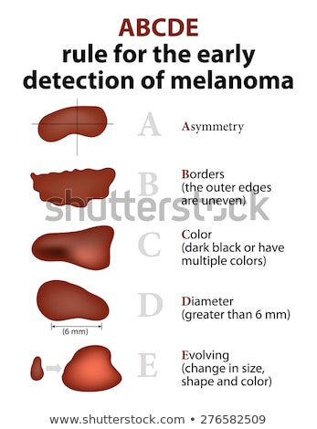 Stockfoto: The Abcd Rules Of Skin Cancer